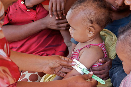 Ethiopian child at helth clinic getting tested for malnutrition . Copyright EU/ECHO/Martin Karimi